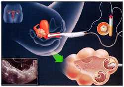 焦作代孕服务,输卵管堵塞的病因和检查方法是什